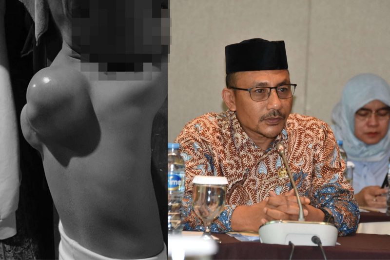 Senator Haji Uma Tanggung Biaya Pendamping Penderita Tumor. NOA.co.id